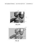 APPARATUS AND METHOD FOR LIGAMENT RECONSTRUCTION diagram and image