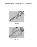 APPARATUS AND METHOD FOR LIGAMENT RECONSTRUCTION diagram and image