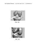 APPARATUS AND METHOD FOR LIGAMENT RECONSTRUCTION diagram and image