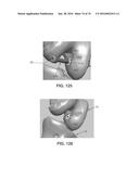 APPARATUS AND METHOD FOR LIGAMENT RECONSTRUCTION diagram and image