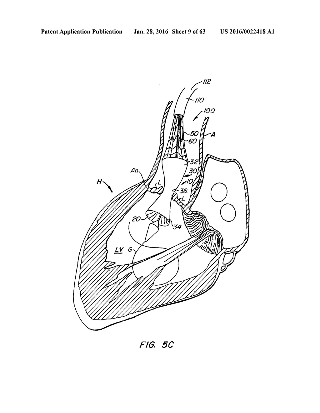 EVERTING HEART VALVE - diagram, schematic, and image 10