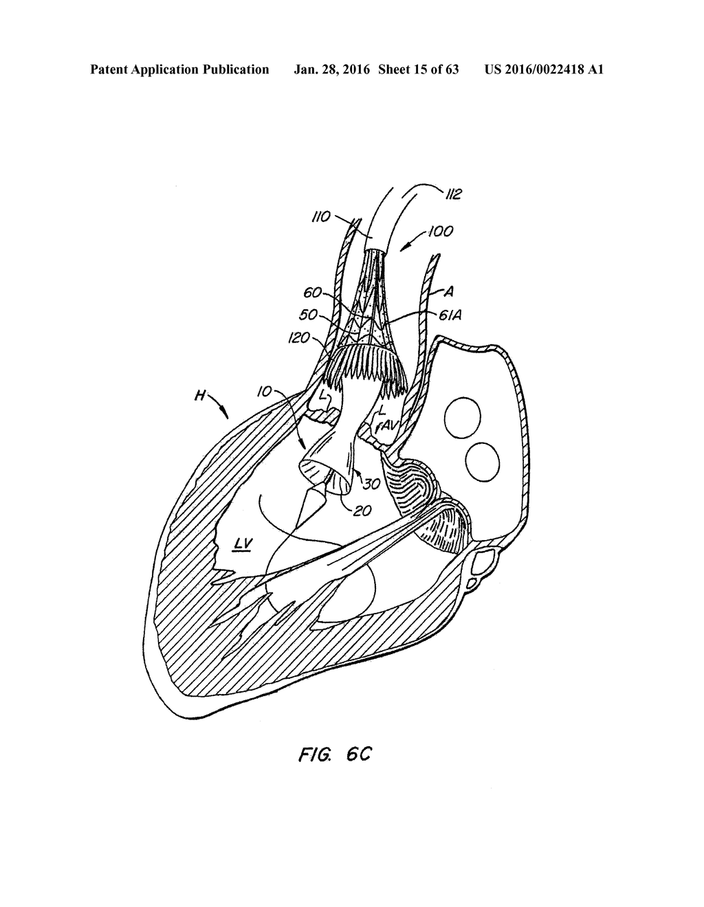 EVERTING HEART VALVE - diagram, schematic, and image 16