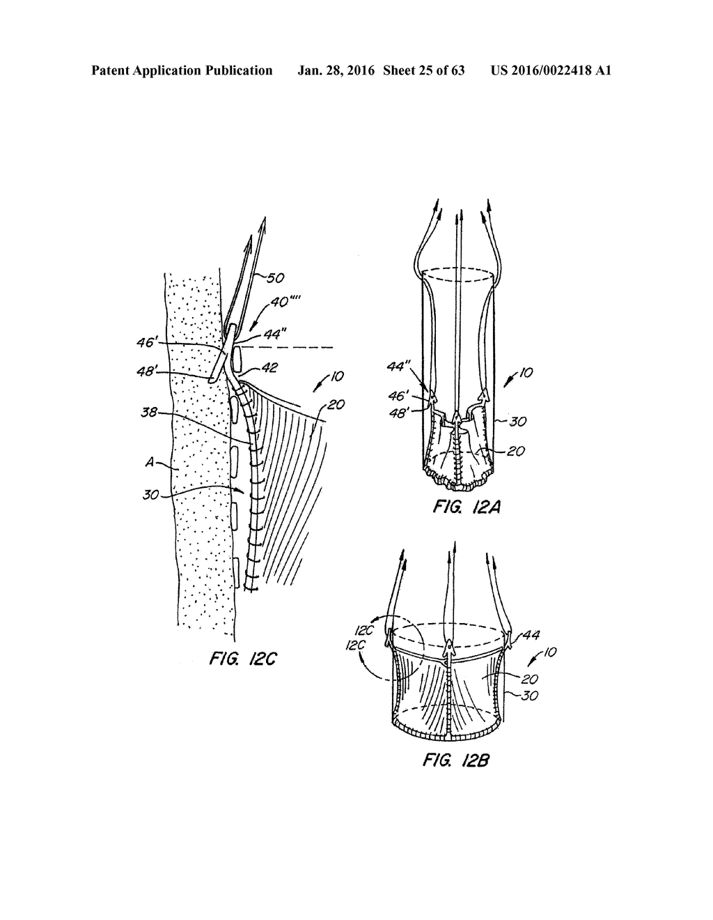 EVERTING HEART VALVE - diagram, schematic, and image 26