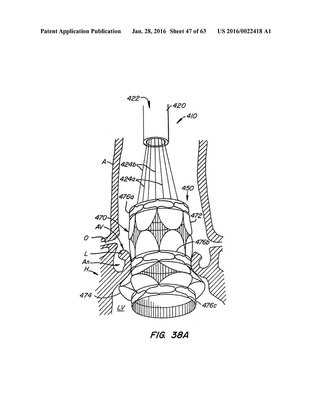 EVERTING HEART VALVE - diagram, schematic, and image 48