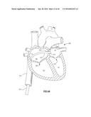 SYSTEMS AND METHODS FOR DELIVERY OF ANNULOPLASTY RINGS diagram and image