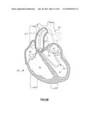 SYSTEMS AND METHODS FOR DELIVERY OF ANNULOPLASTY RINGS diagram and image