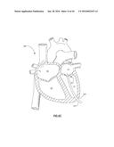 SYSTEMS AND METHODS FOR DELIVERY OF ANNULOPLASTY RINGS diagram and image