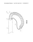 SYSTEMS AND METHODS FOR DELIVERY OF ANNULOPLASTY RINGS diagram and image