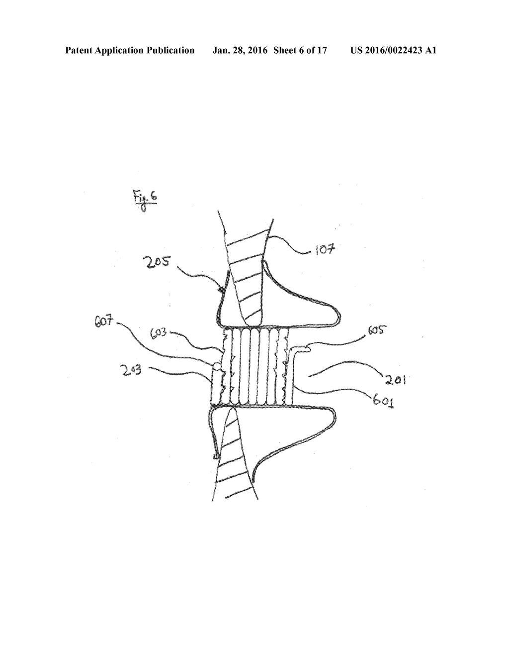 METHODS, SYSTEMS, AND DEVICES FOR RESIZABLE INTRA-ATRIAL SHUNTS - diagram, schematic, and image 07