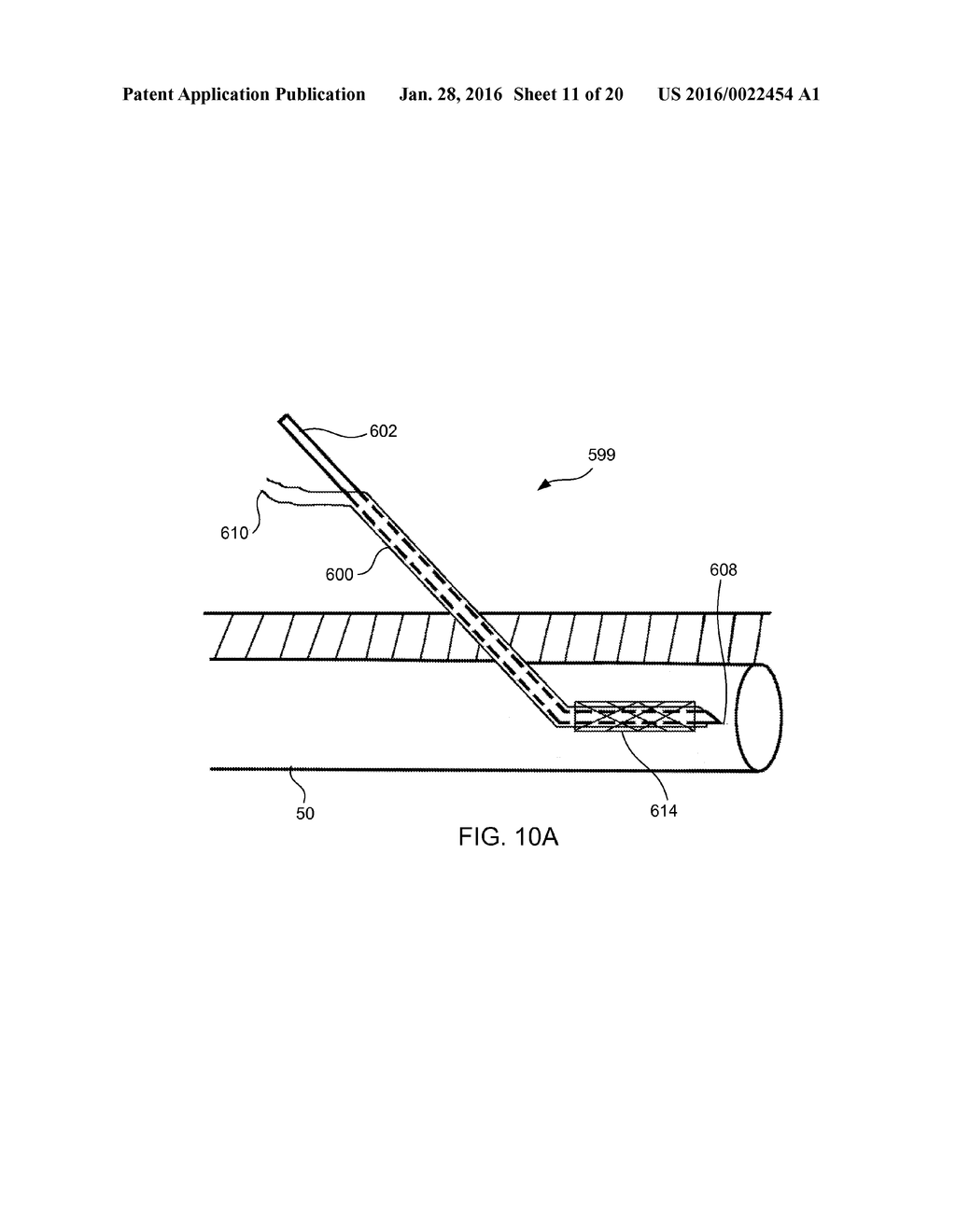 ANATOMIC NEEDLE SYSTEM - diagram, schematic, and image 12