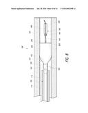 LUMINAL STENTING diagram and image