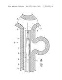 LUMINAL STENTING diagram and image