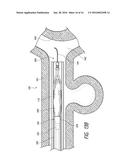 LUMINAL STENTING diagram and image