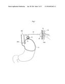 METHOD AND INSTRUMENT FOR TREATING OBESITY diagram and image