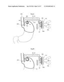 METHOD AND INSTRUMENT FOR TREATING OBESITY diagram and image