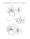 METHOD AND INSTRUMENT FOR TREATING OBESITY diagram and image