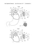 METHOD AND INSTRUMENT FOR TREATING OBESITY diagram and image