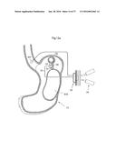 METHOD AND INSTRUMENT FOR TREATING OBESITY diagram and image