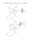 METHOD AND INSTRUMENT FOR TREATING OBESITY diagram and image