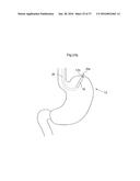 METHOD AND INSTRUMENT FOR TREATING OBESITY diagram and image