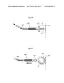 METHOD AND INSTRUMENT FOR TREATING OBESITY diagram and image