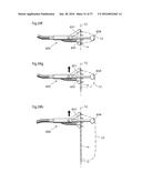 METHOD AND INSTRUMENT FOR TREATING OBESITY diagram and image