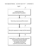 METHOD AND INSTRUMENT FOR TREATING OBESITY diagram and image