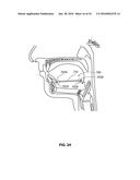 SYSTEMS AND METHODS FOR TREATMENT OF SLEEP APNEA diagram and image