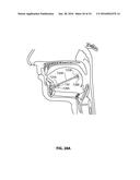 SYSTEMS AND METHODS FOR TREATMENT OF SLEEP APNEA diagram and image