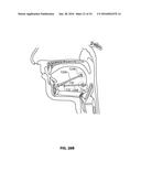 SYSTEMS AND METHODS FOR TREATMENT OF SLEEP APNEA diagram and image