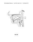 SYSTEMS AND METHODS FOR TREATMENT OF SLEEP APNEA diagram and image