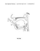 SYSTEMS AND METHODS FOR TREATMENT OF SLEEP APNEA diagram and image