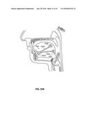 SYSTEMS AND METHODS FOR TREATMENT OF SLEEP APNEA diagram and image