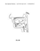 SYSTEMS AND METHODS FOR TREATMENT OF SLEEP APNEA diagram and image