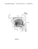 SYSTEMS AND METHODS FOR TREATMENT OF SLEEP APNEA diagram and image