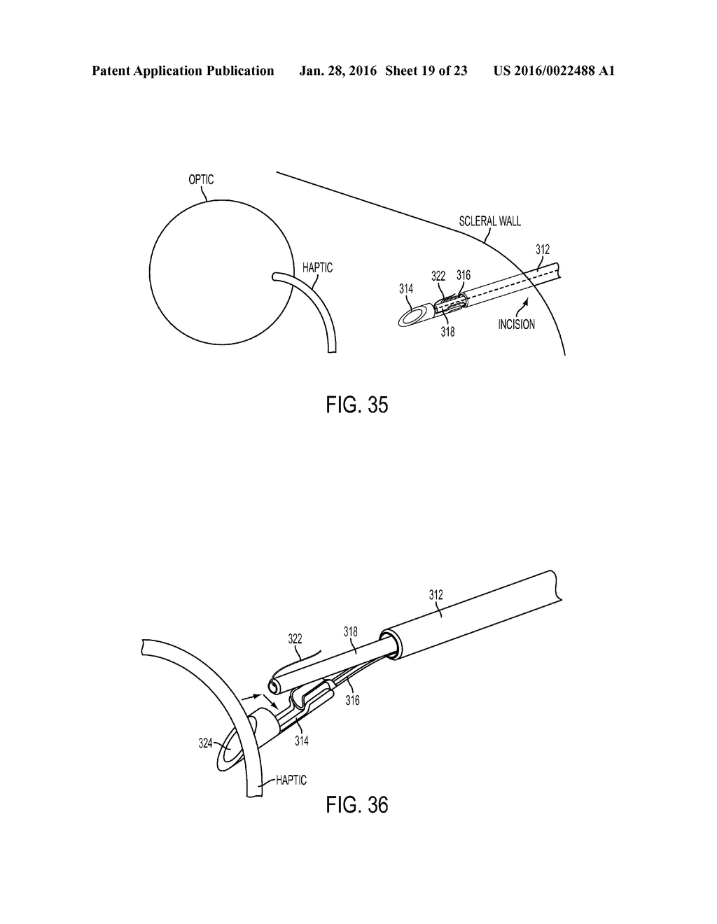 INTRAOCULAR LENS FIXATION CORRECTION METHODS AND DEVICES - diagram, schematic, and image 20