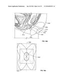 DEVICES AND METHODS FOR TREATING ACCIDENTAL BOWEL LEAKAGE diagram and image