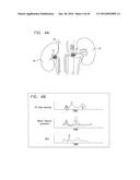 RENAL PUMP diagram and image