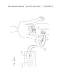 RENAL PUMP diagram and image