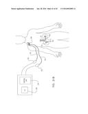 RENAL PUMP diagram and image