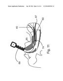 METHOD AND APPARATUS FOR DETERMINING OPTIMAL ENDOTRACHEAL TUBE SIZE diagram and image