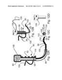 METHOD AND APPARATUS FOR DETERMINING OPTIMAL ENDOTRACHEAL TUBE SIZE diagram and image