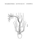 INTRALUMINAL DEVICES AND SYSTEMS diagram and image