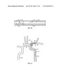 INTRALUMINAL DEVICES AND SYSTEMS diagram and image