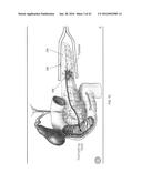 INTERVENTIONAL DRUG DELIVERY SYSTEM AND ASSOCIATED METHODS diagram and image