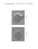 INTERVENTIONAL DRUG DELIVERY SYSTEM AND ASSOCIATED METHODS diagram and image