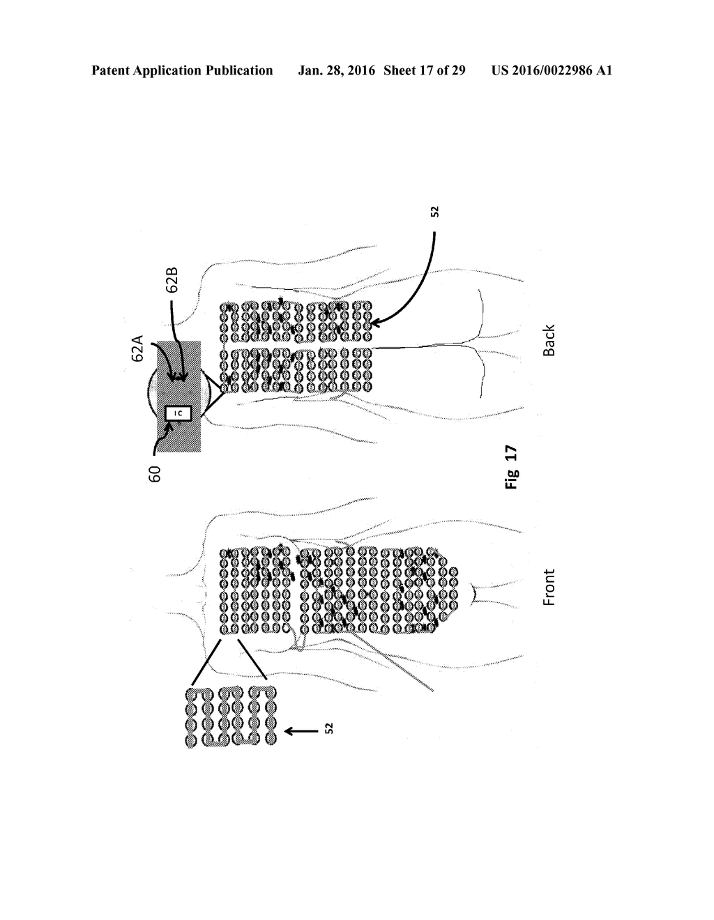 APPARATUS AND METHOD FOR TREATING MULTIPLE TUMORS IN PATIENTS WITH     METASTATIC DISEASE BY ELECTRIC FIELDS - diagram, schematic, and image 18