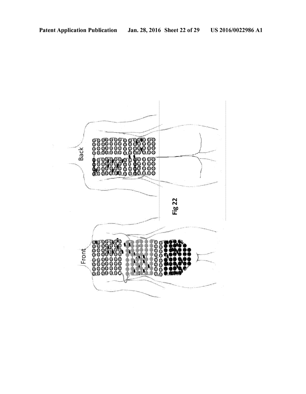 APPARATUS AND METHOD FOR TREATING MULTIPLE TUMORS IN PATIENTS WITH     METASTATIC DISEASE BY ELECTRIC FIELDS - diagram, schematic, and image 23