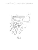 METHOD AND APPARATUS FOR DETECTING AND DISCRIMINATING TACHYCARDIA IN A     SUBCUTANEOUSLY IMPLANTABLE CARDIAC DEVICE diagram and image