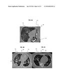 SYSTEM AND METHOD FOR IRRADIATION THERAPY USING VOXEL BASED FUNCTIONAL     MEASUREMENTS OF ORGANS AT RISK diagram and image